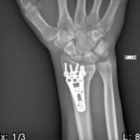 Fotos de Nicolas Chanavat